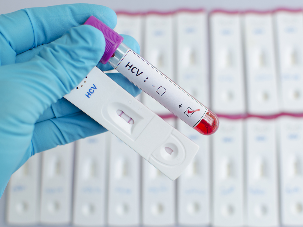 Hepatitis C virus (HCV) testing by using test cassette, the result showed positive (double red line)